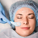 chemical peel