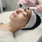 Woman receiving RF microneedling treatment for skin rejuvenation